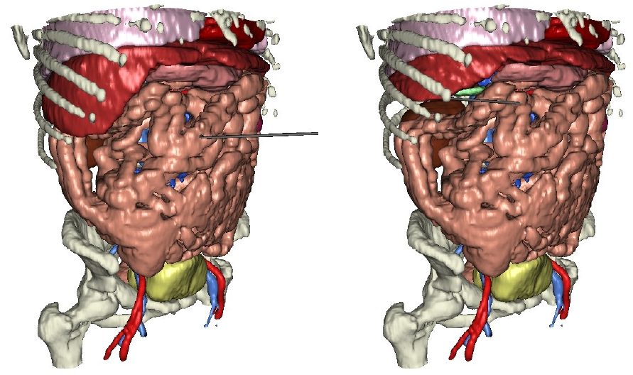 patient-specific model